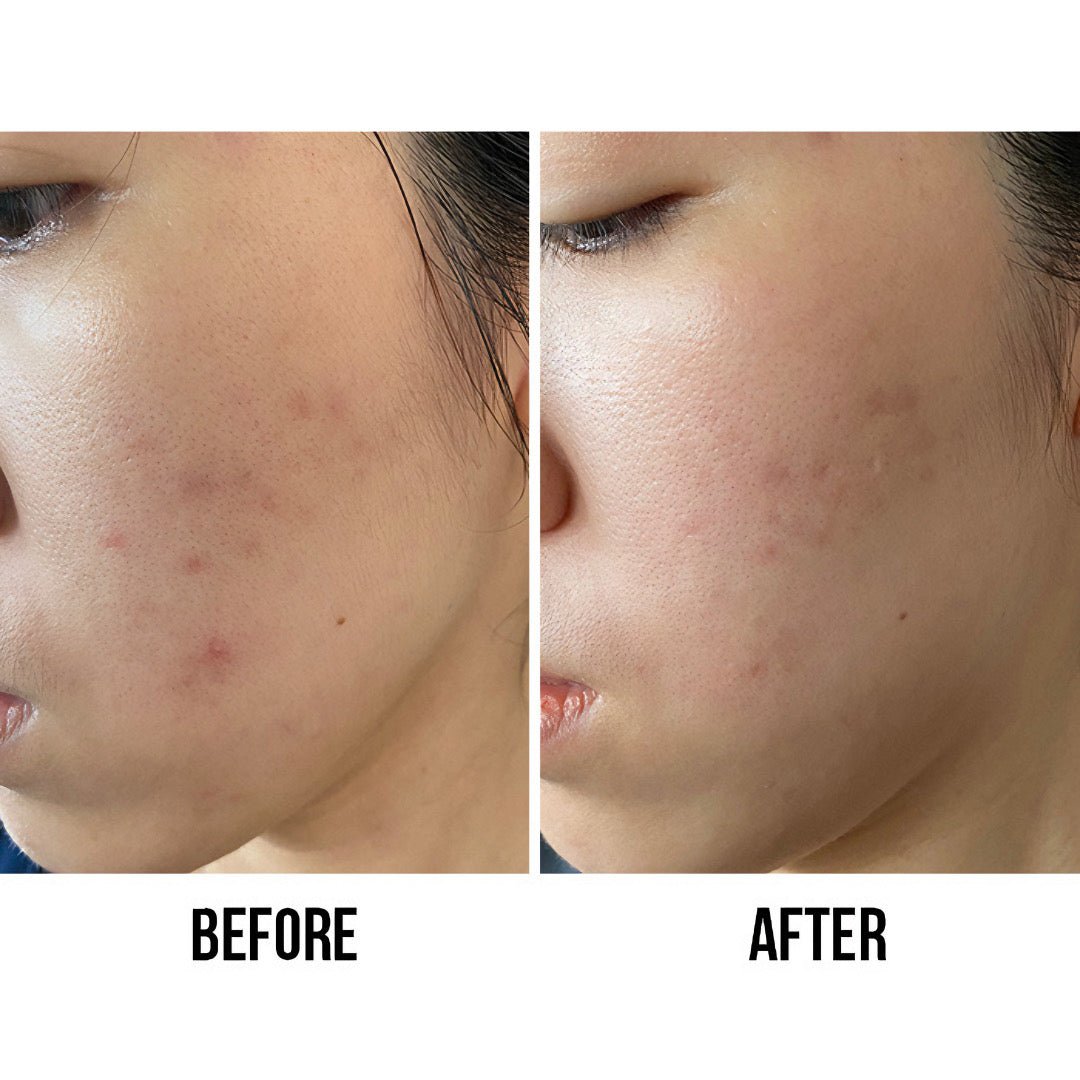 La Roche Posay Effaclar Ultra Concentre Serum 30ml - Avoriell