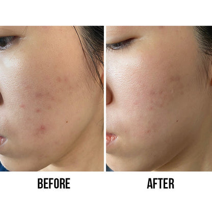 La Roche Posay Effaclar Ultra Concentre Serum 30ml - Avoriell